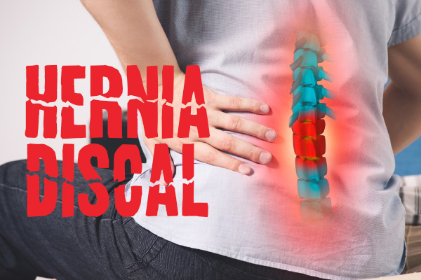 Hernia discal