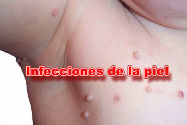 ¿Qué son las infecciones de la piel?