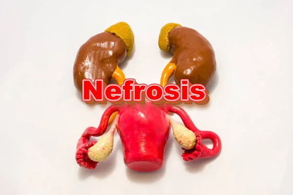 Nefrosis