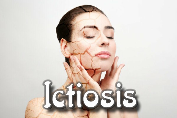 Ictiosis