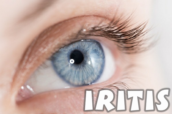 ¿Qué es la iritis?