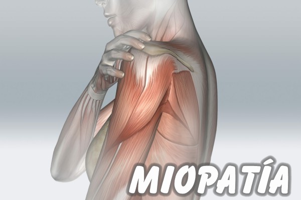 Miopatías