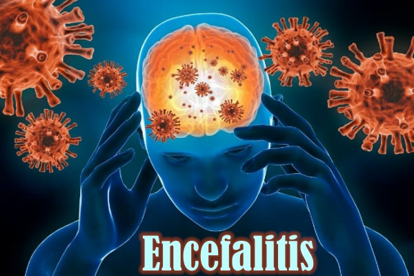 Encefalitis